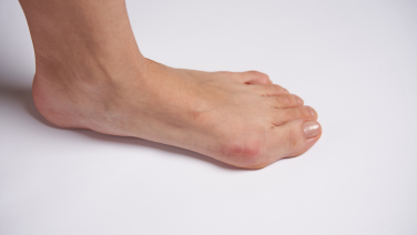 Hallux valgus - A malposition of the big toe: Causes, symptoms and treatment